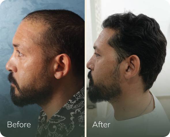 Hair transplant before and after