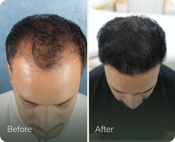 Hair transplant before and after