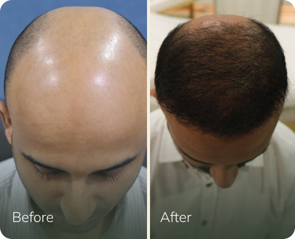 Hair transplant before and after