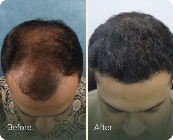 Hair transplant before and after