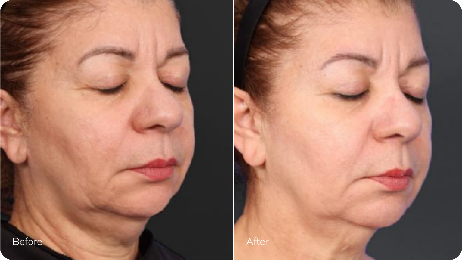 XERF Before After