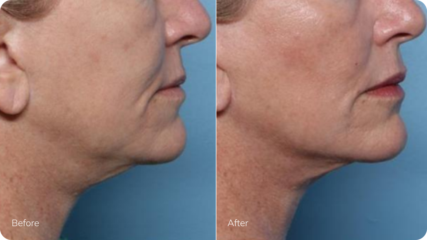 XERF Before After