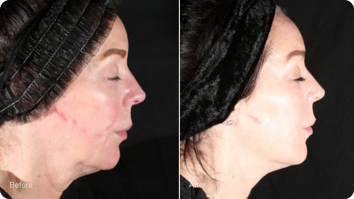 XERF Before After