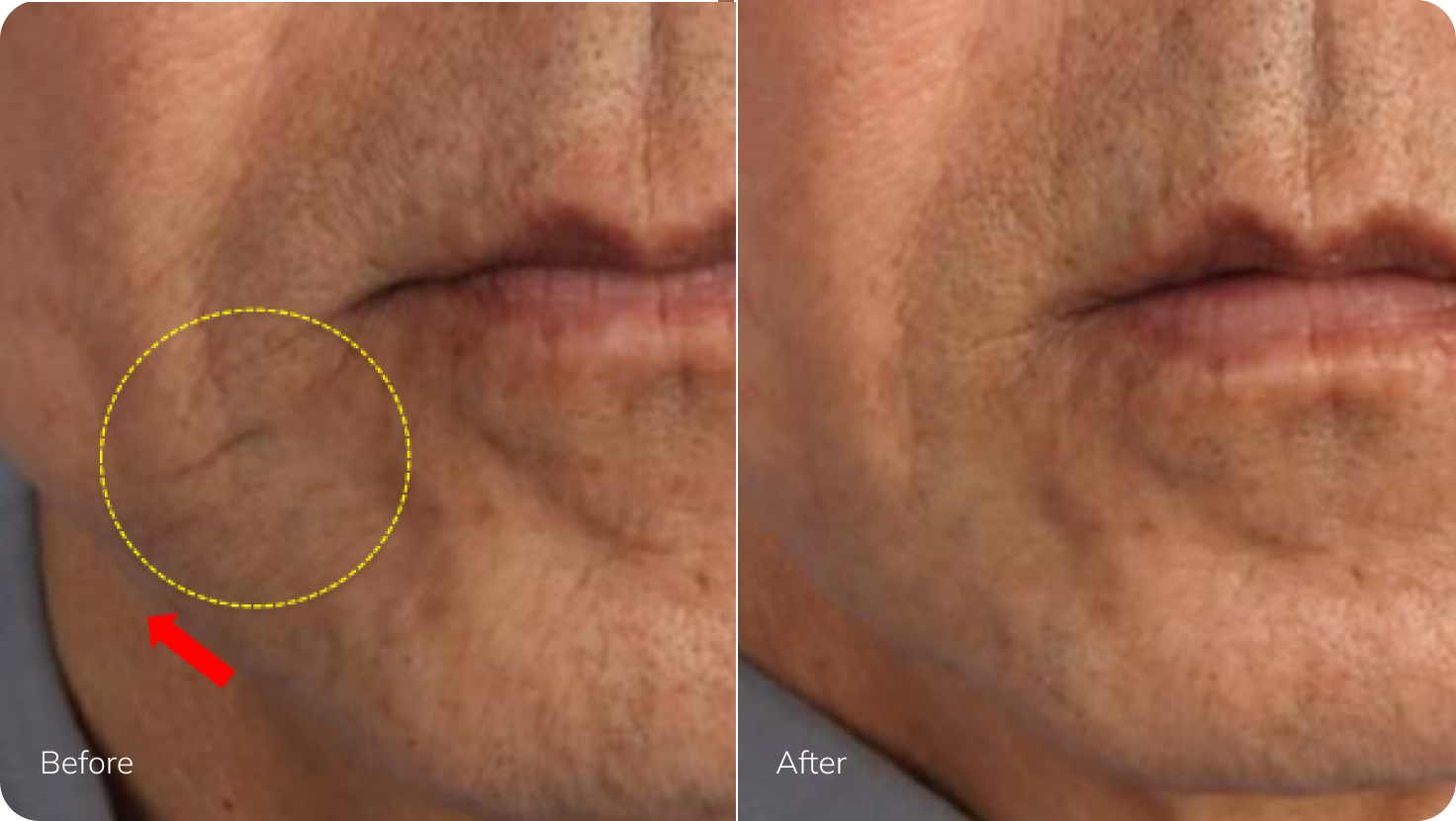 XERF Before After