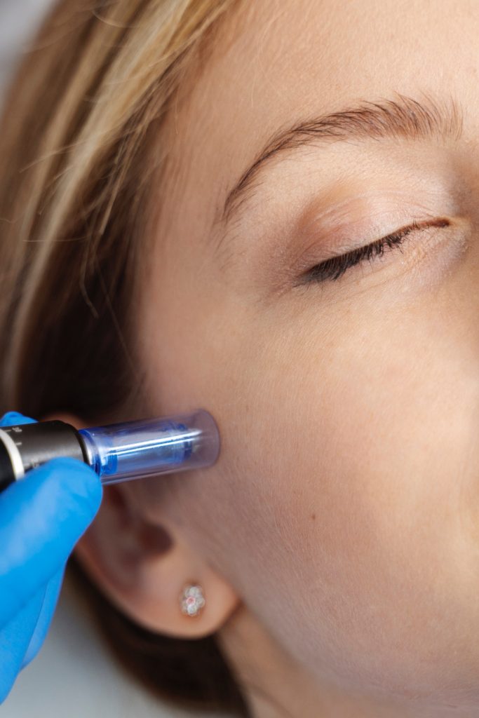 Top 10 Questions we get asked at Dermanude Skin Clinic for our SkinPen Microneedling Treatment