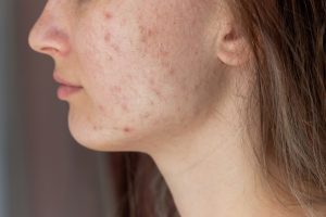 The Best Treatments for Facial Acne Scars, Dermanude Skin Clinic Manchester