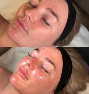 Why HydraFacial Is the Ultimate Skin Treatment