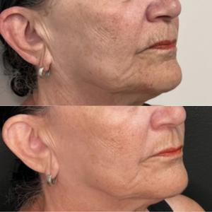 The Secret to Firmer, Youthful Skin with Forma Radio Frequency