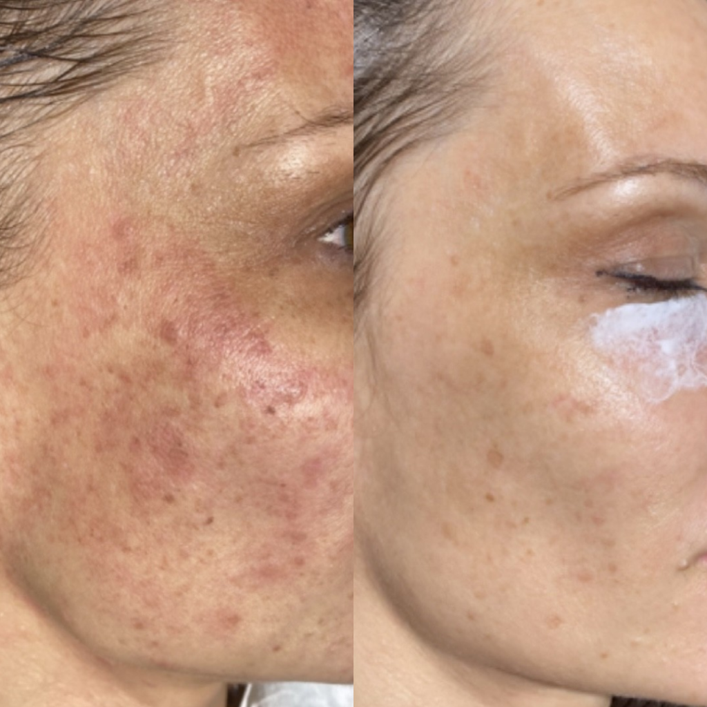 Lumecca IPL Treatment Altrincham, Dermanude Skin Specialists