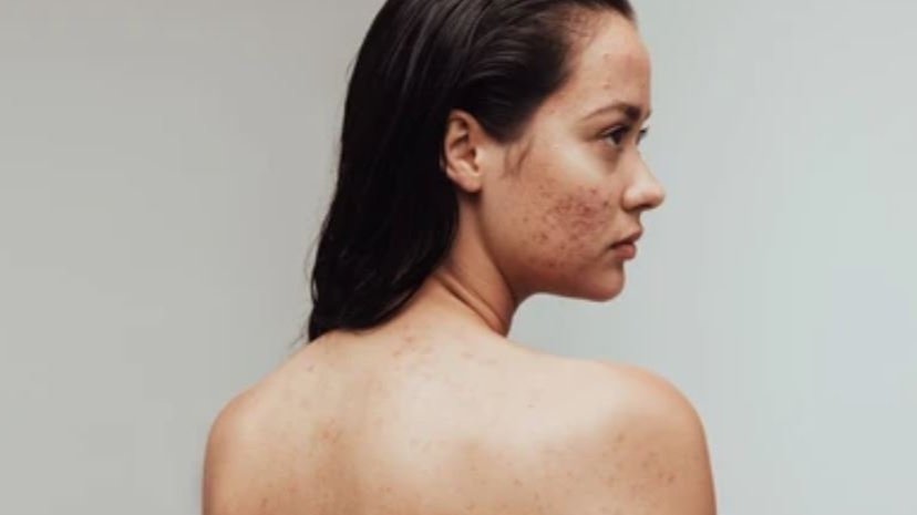 Treating acne scars with skinpen microneedling