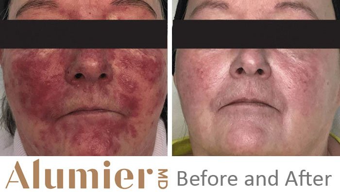 Can rosacea be treated?