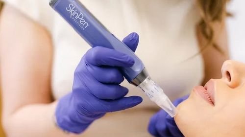 Skinpen microneedling for hyperpigmentation