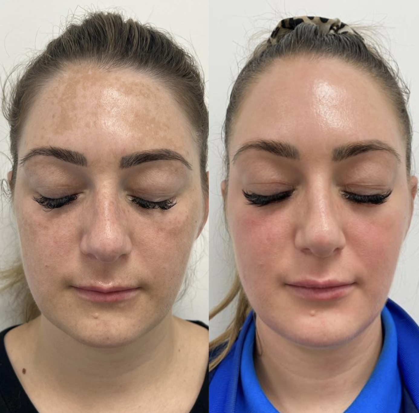 Summer Pigmentation: How to Protect and Treat Your Skin