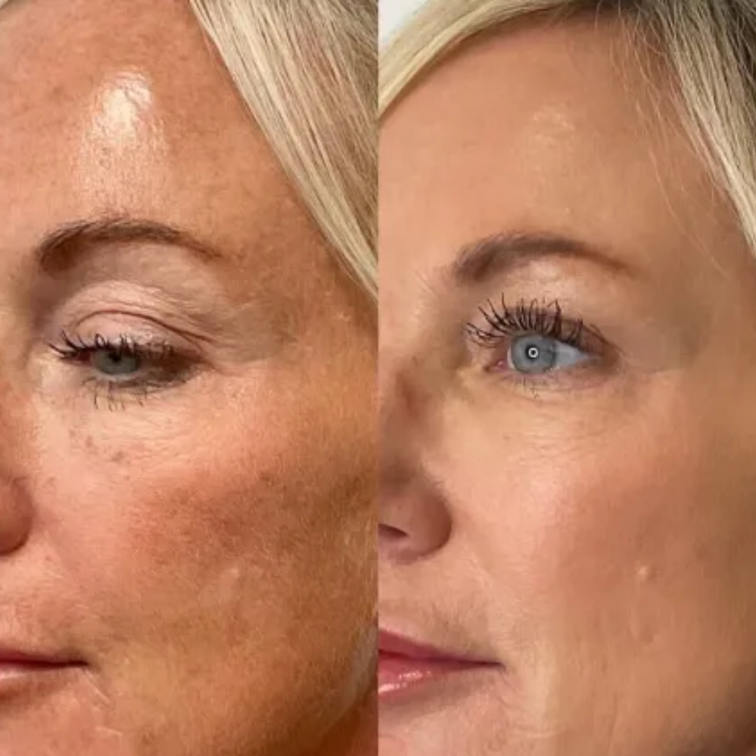 Illuminate Your Skin: Why Lumecca IPL at Dermanude Is a Game Changer