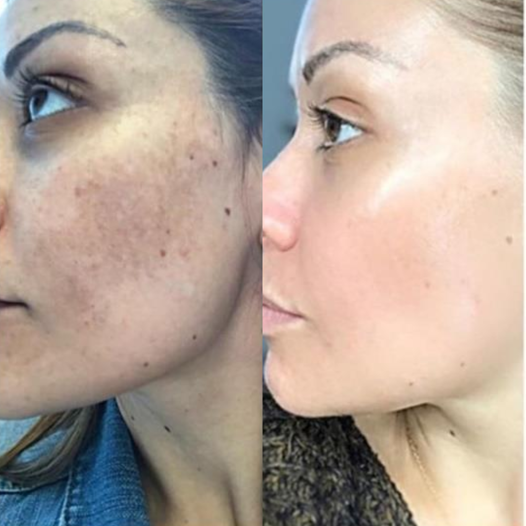 How to Treat Stubborn Pigmentation: Why Cosmelan is the Gold Standard for Clearer Skin