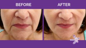 cosmetic threads face lifting