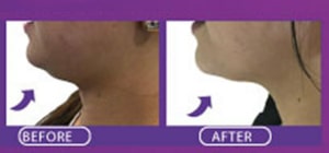 LIPOLYSIS-INJECTION-FOR-DOUBLE-CHIN-dubai