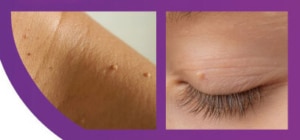 SKIN-TAGS-REMOVAL--dubai