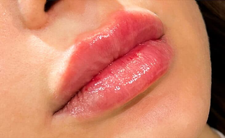 dermal fillers dubai 2023 - Derma One Medical Center