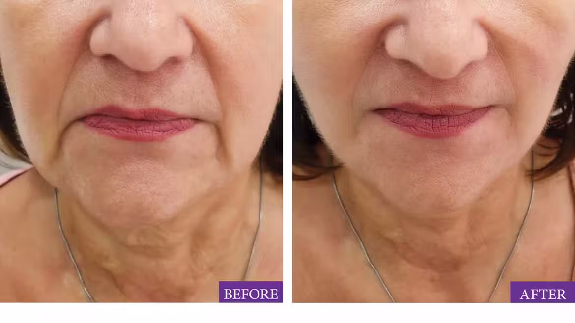 Can Botox Lift Your Face in Dubai?