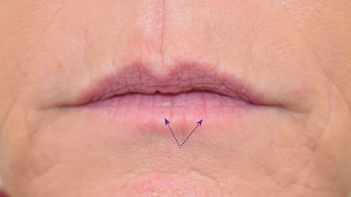 Does Botox work for wrinkles around mouth / lips