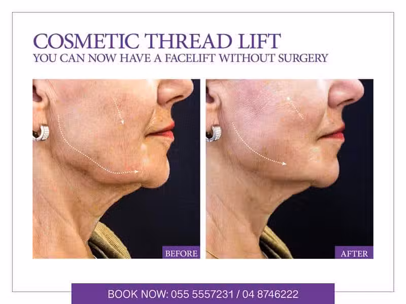 thread lift in dubai