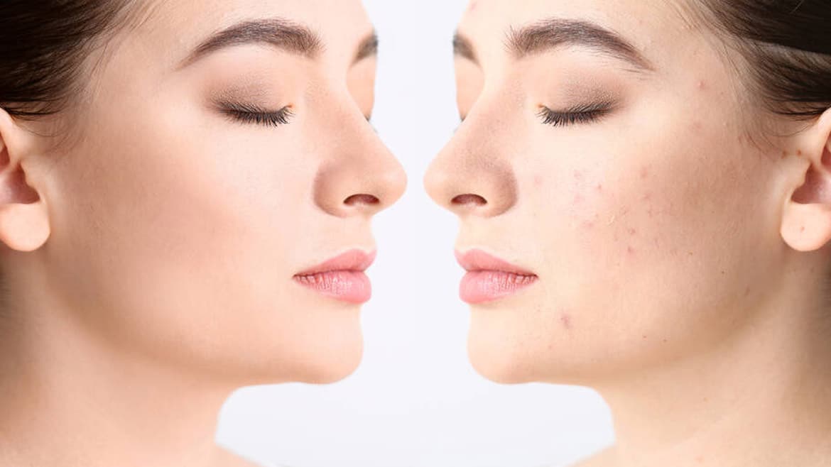 Laser Scar Treatment Dubai