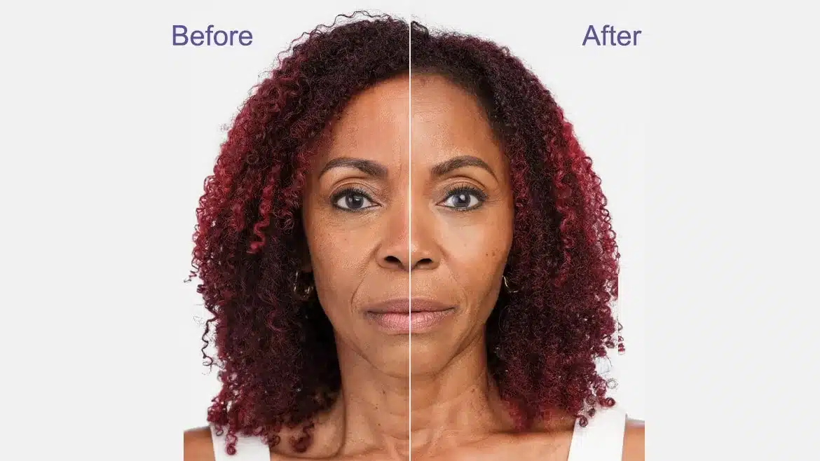 before using radiesse