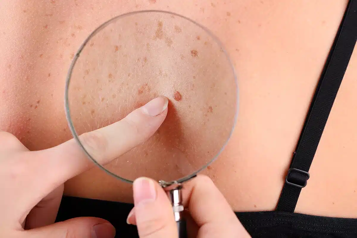 skin tag removal in Dubai