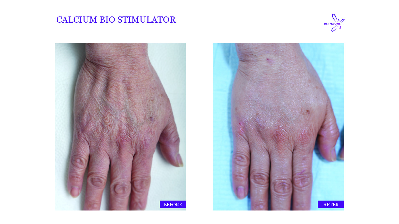 Calcium bio stimulator for hands