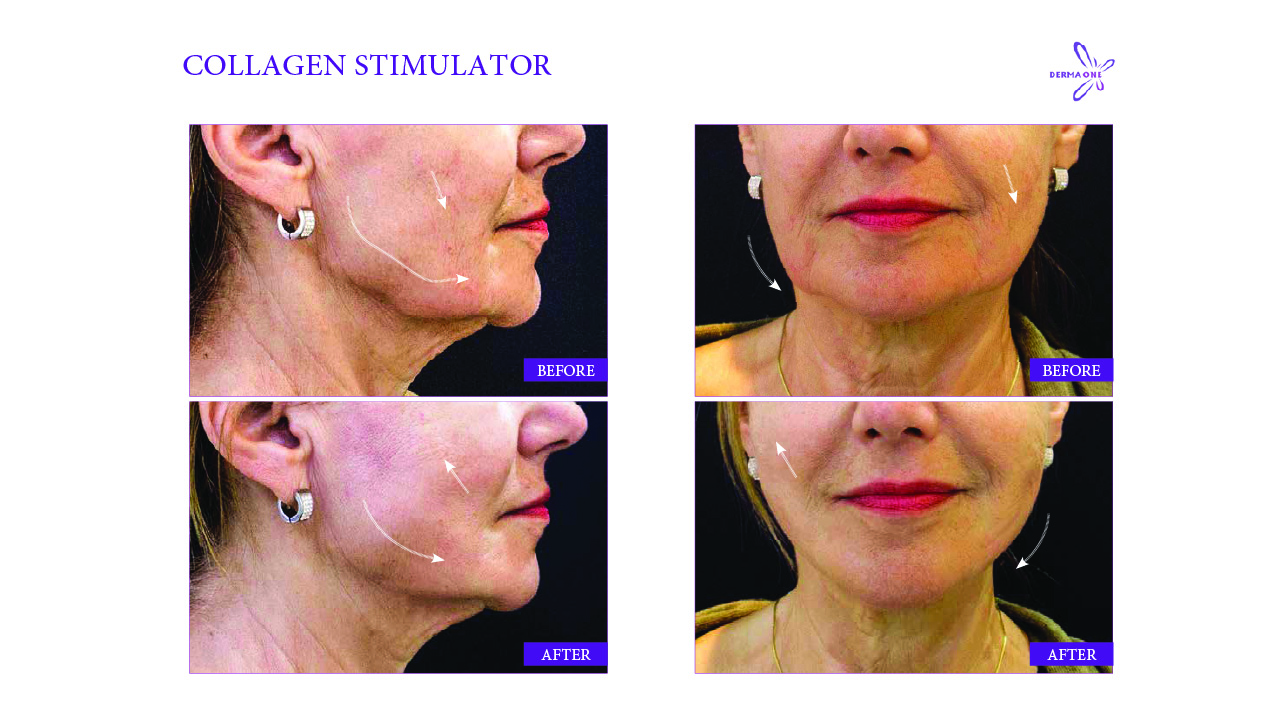 Collagen stimulator
