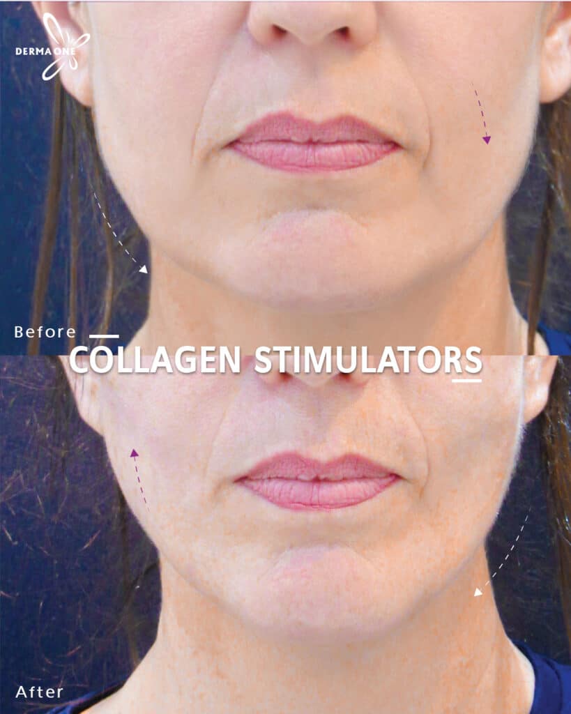COLLAGEN STIMULATORS