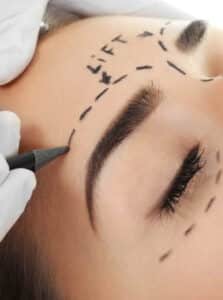 Eyebrow Lift