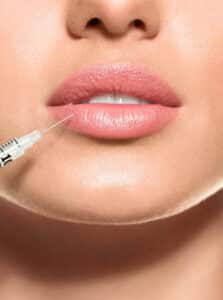 Lip Fillers