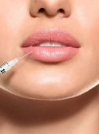 Lip Fillers