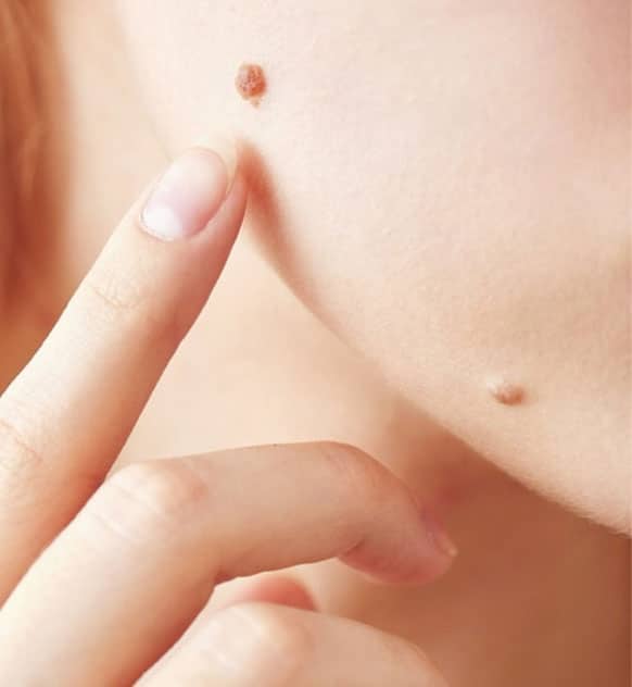 skin tags andd moles