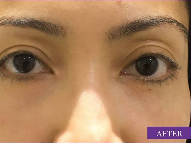 after under eye filler