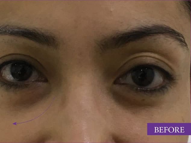 before under eye filler
