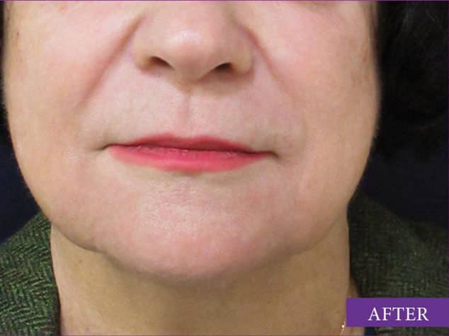 marionette lines and lifting