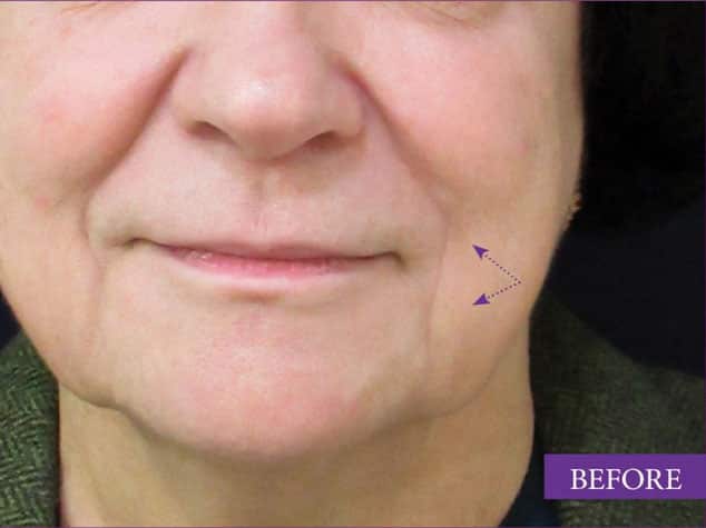 marionette lines and lifting