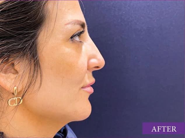 Jaw Slimming Botox Dubai before and after results
