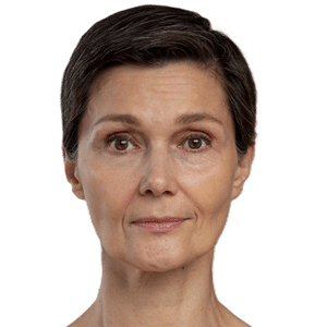 Marionette lines Filler dubai