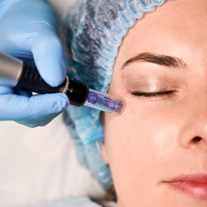 Microneedling with PRF Dubai 300x300