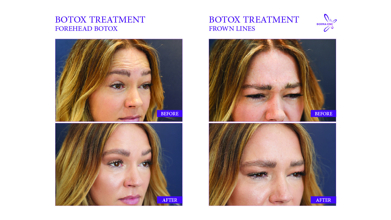 BOTOX TREATMENT 