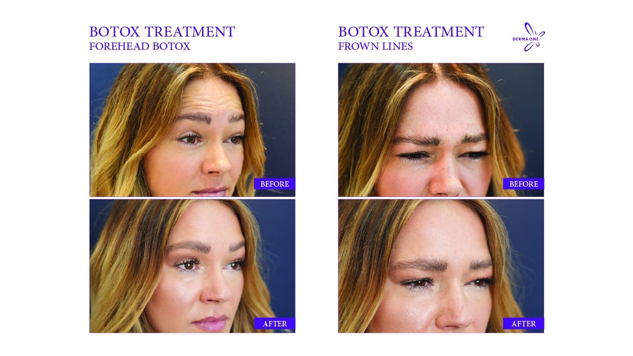 BOTOX TREATMENT