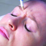 Botox Results Look Uneven