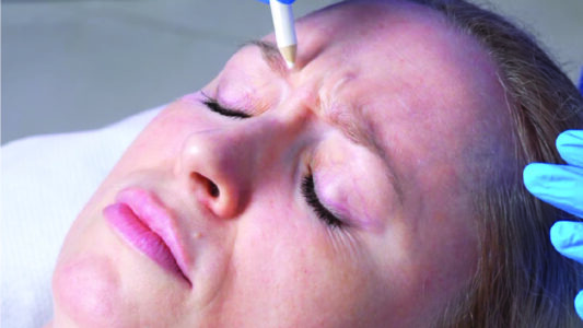 Botox Results Look Uneven