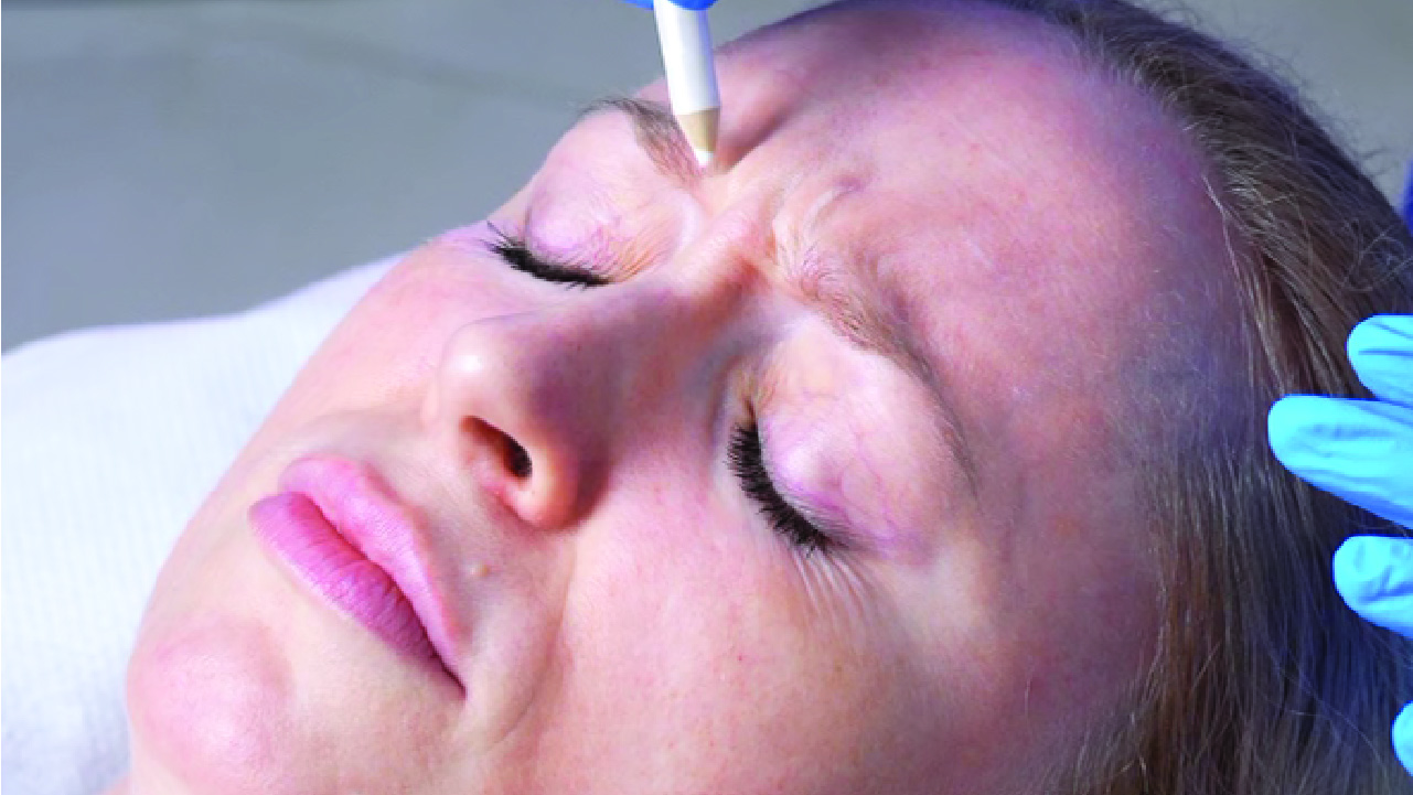 Botox Results Look Uneven