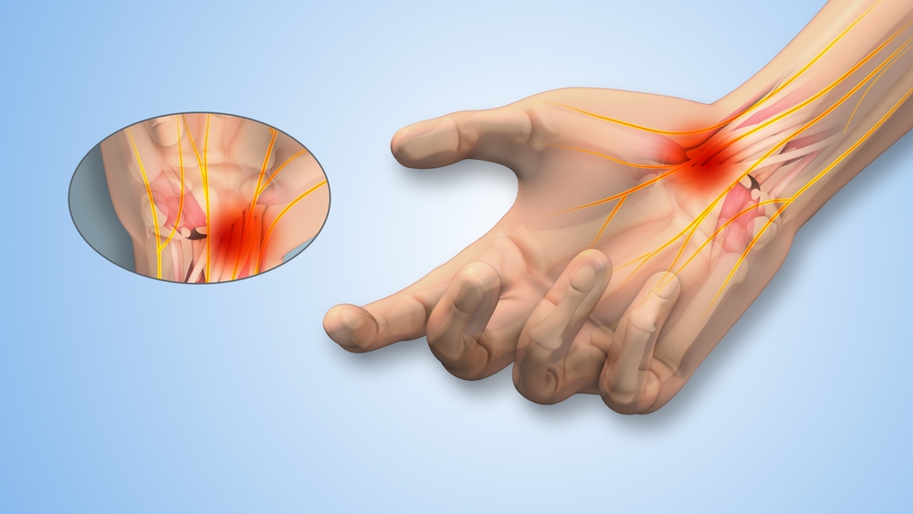 Carpal Tunnel Surgery: From Pain Relief to Recovery