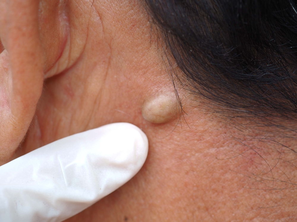 Is Cyst Removal Painful? A Guide for Patients in Surrey